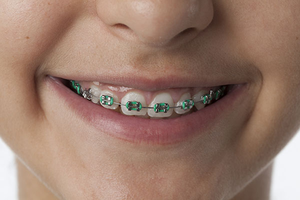 Metal Braces Treatment in Spring, Tx